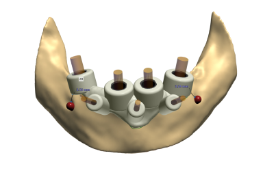 sagalign aligners stacked