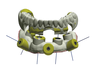 sagalign aligners stacked